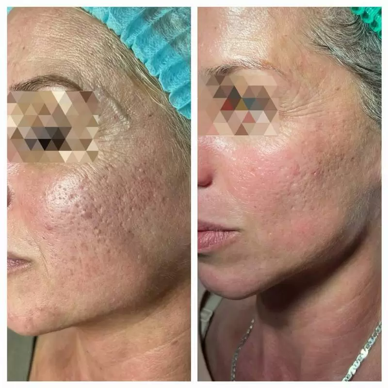 ožiljci na licu pre i posle