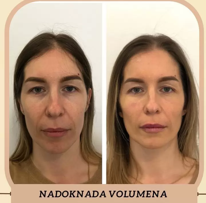 podmlađivanje lica pre i posle tretman